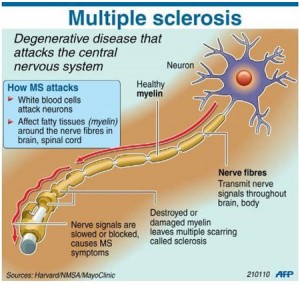 Multiple Sclerosis Image