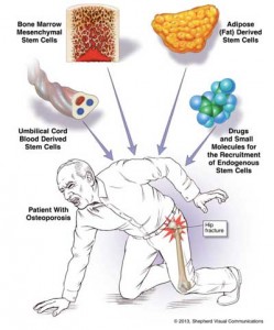Osteoporosis-stem-cell